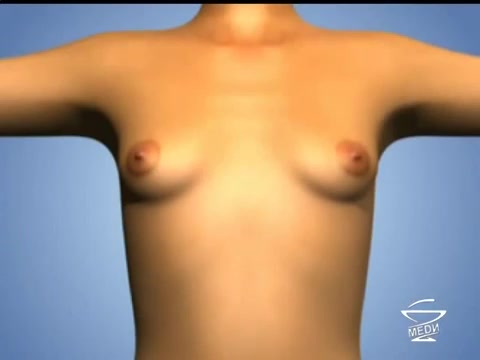 Современная коррекция размеров и форм груди