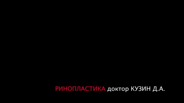 Ефективна ринопластика - відгук про пластику носа